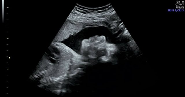 The difference in side profiles at 27 weeks and 14 weeks!
#thorstudio #bondingbeforebirth #fromthewombtotheworld #maternalsupport #momssupportingmoms